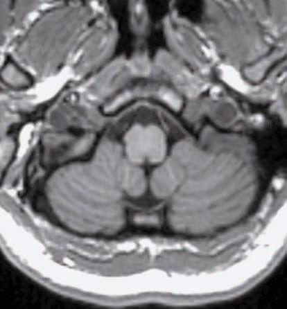 1 Nelle successive tavole sono riportate sezioni assiali, coronali e sagittali mirate alla valutazione dell anatomia cerebellare.