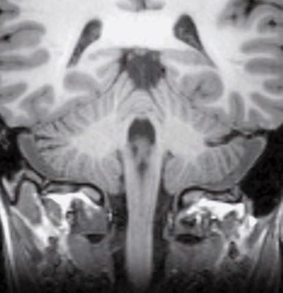 64 SEZIONI CORONALI Lobulo quadrangolare Scissura primaria Lobulo semplice Scissura orizzontale Lobulo biventre IV ventricolo Peduncolo cerebellare medio Flocculo Bulbo Midollo Lobulo quadrangolare