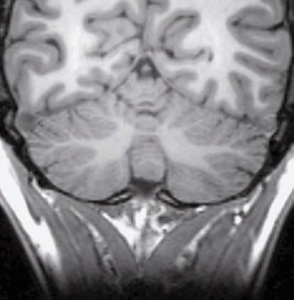 semplice Scissura postero Lobulo quadrangolare Culmen Lobulo semilunare Scissura orizzontale Lobulo semilunare Nodulo Uvula Tonsilla