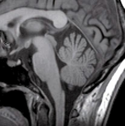 Sezioni sagittali 71 Lobulo quadrangolare Ala del lobulo centrale Frenulo della lingula Peduncolo cerebellare medio Scissura primaria Lobulo semplice Scissura postero Lobulo semilunare Scissura