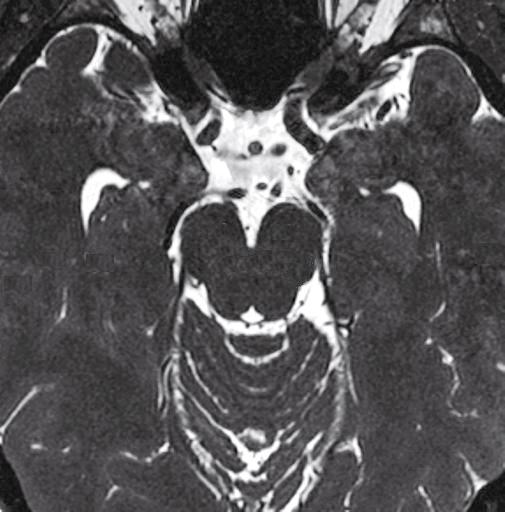 80 4 Nervi cranici N. ottico (II) Peduncolo ipofisario N. oculomotore (III) Apice di basilare N. oculomotore (III) Arteria cerebrale posteriore N. trocleare (IV) N.