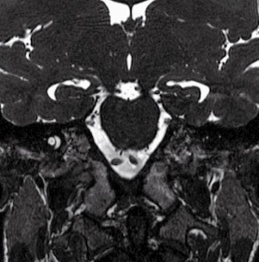 82 4 Nervi cranici III ventricolo Arteria cerebrale posteriore N. oculomotore (III) Arteria cerebellare Cavo di Meckel Cella media Forame del Monro N. oculomotore (III) N. abducente (VI) N.