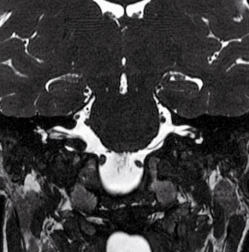 glossofaringeo (IX) N. vago (X) N. accessorio (XI) Canale del N. ipoglosso (XII) Arterie vertebrali Fig. 4.
