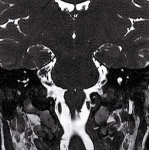 trocleare (IV) III ventricolo Arteria cerebellare posteriore- N.