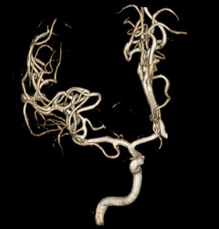 94 5 Vasi arteriosi M4 MCA M3 MCA A1 ACA M2 MCA Silvian bi-triforcation M1 MCA Lenticolo-striate arteries Anterior temporal artery Middle internal frontal artery Anterior internal frontal artery