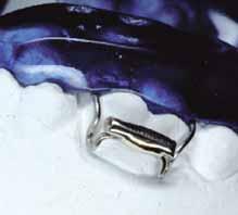 aumentare l ancoraggio soprattutto nei casi di dentatura decidua, quando anche i molari permanenti non erotti del tutto non permettono una