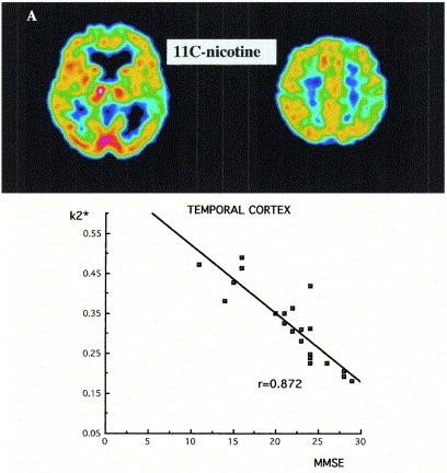 Nordberg A Nicotinic receptor abnormalities of Alzheimer s disease: therapeutic implications.