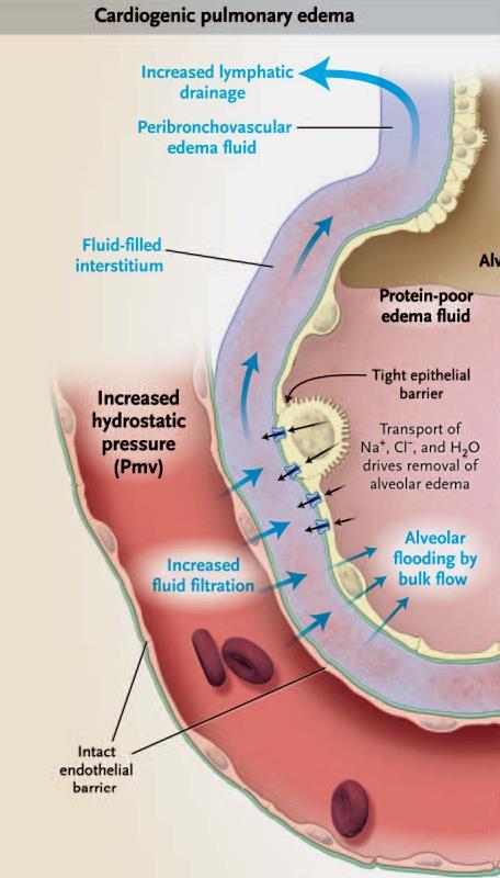 Edema cardiogeno filtrazione di liquido