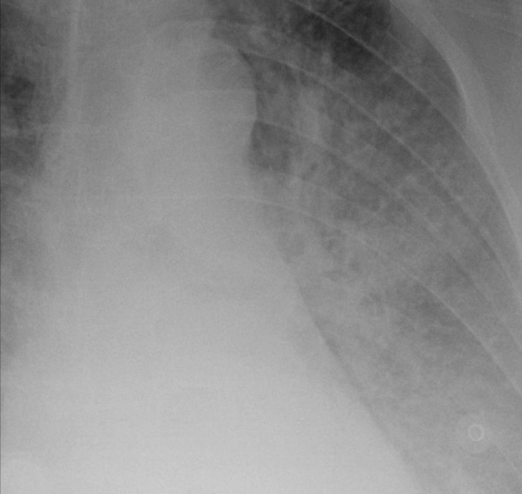 interstizio e poi negli alveoli