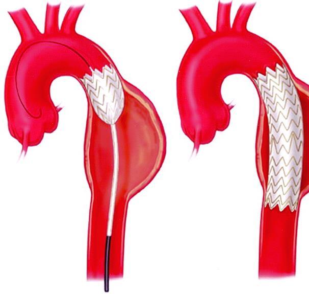 Thoracic aortic endovascular repair (TEVAR) Si esclude l aneurisma con l inserimento di uno più stent aortici autoespandibili Stent: protesi endovascolare tubulare, costituita da una struttura