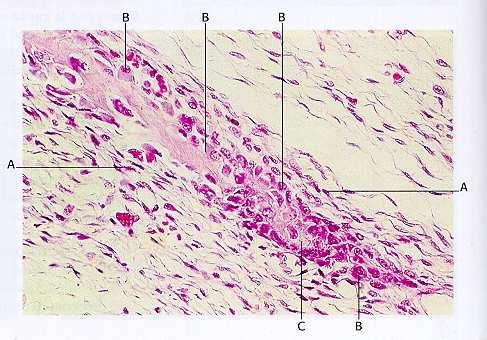 Ossificazione intramembranosa o diretta fibroblasti osteoblasti osteoclasti sostanza fondamentale L osso si forma direttamente dal mesenchima: i fibroblasti si differenziano in