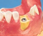 L impianto dentale viene inserito solo dopo che la ricostruzione ossea è completa 9 2a Uso di Geistlich Bio-Oss Riempimento del difetto osseo con Geistlich Bio-Oss per formare nuovo osso.