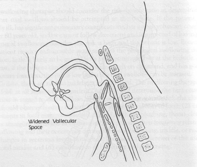 POSTURE FACILITANTI aumentano la sicurezza modificano direzione del bolo modificano dimensioni del faringe non lavoro o sforzo del cliente (neurologici, operati, qualunque età) migliore transito