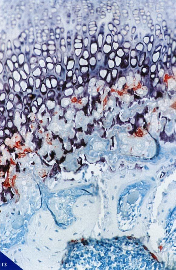 In condizioni normali, all'estremità epifisaria della zona proliferativa della cartilagine di coniugazione, i condrociti si moltiplicano con una velocità che eguaglia quella delle cellule che