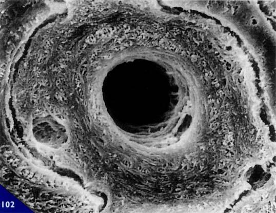 Al microscopio a luce ordinaria o a luce polarizzata si evidenzia come le lacune osteocitarie sono presenti sempre all interno delle aree di tessuto mineralizzato che appaiono estinte, dove la trama