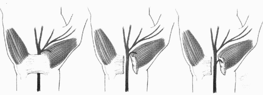 varianti della branca motrice in rapporto al margine distale del legamento trasverso eziopatogenesi causa primaria è la compressione nervosa all interno del canale carpale legata all