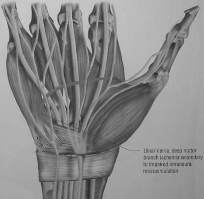 ipotenari ischemia della branca motrice