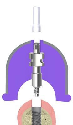 In alternativa, è possibile costruire la mascherina gengivale sul modello master iniettando materiale gengivale in uno stampo in putty che è stato riposizionato sul modello preparato.