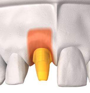 c. In base alla posizione, alla vicinanza di denti adiacenti e all occlusione, scegliere la cappetta anatomica preformata più adatta.