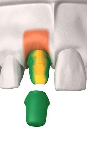 uno specifico orientamento relativamente alla posizione rotazionale dell impianto.