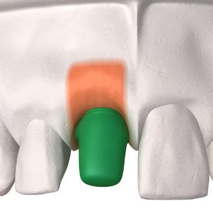 Il moncone calcinabile può essere modificato fino ad ottenere il profilo di emergenza, il contorno e la forma occlusale ottimali.