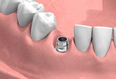 I Pilastri in Zirconio sono costituiti da due parti: la cappetta in Zirconio, con un profilo che corrisponde ai Tissue Former, e un NeoLink Mono in titanio pre-sabbiato.