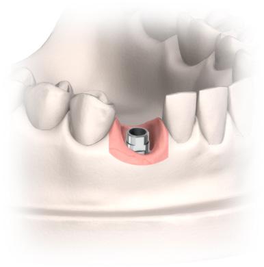 Il foro di accesso della vite viene quindi riempito con un materiale adeguato e si rileva un impronta convenzionale per ponti e corone. È possibile utilizzare il filo retrattore. 9.