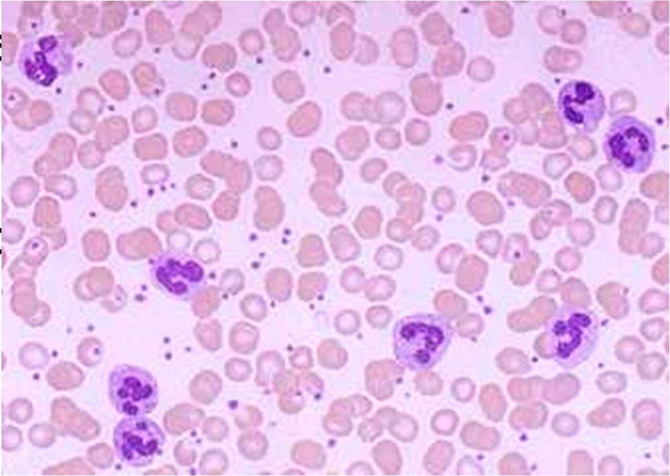 Patologie associate ai globuli bianchi LEUCOCITOSI (aumento numero) Neutrofilia infezioni batteriche Neutrofilia Linfocitosi virus Eosinofilia Allergie & infezioni da