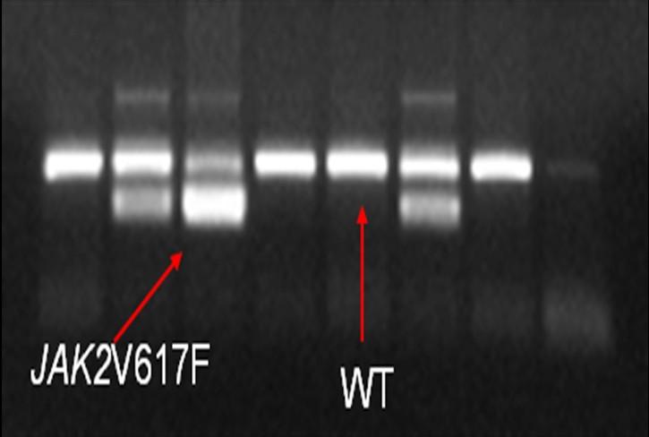 Fig. 3 Mutazione V617FJAK2: PCR allele-