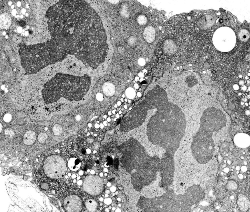 IL NUCLEO apoptosi Successivamente si degrada la membrana nucleare che diventa discontinua e le molecole di DNA