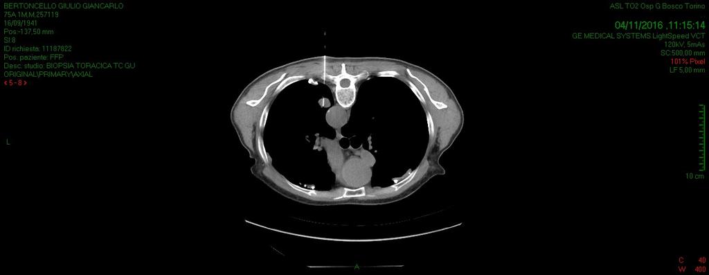 Torniamo a caso clinico PET total body: anomalo focale accumulo in corrispondenza del segmento apicale del lobo inferiore polmonare sn.