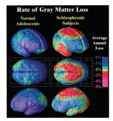 Aspetti neurodegenerativi nella