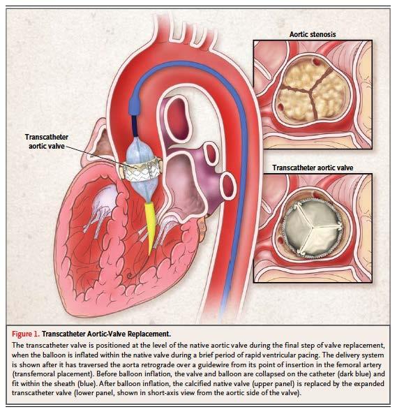 La TAVI permette il trattamento dei pazienti con stenosi aortica severa non