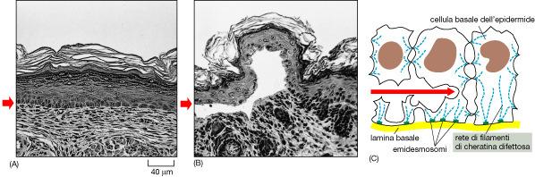 EPITELIO PAVIMENTOSO COMPOSTO CHERATINIZZATO: EPIDERMIDE -Mutazioni nei geni delle cheratine possono causare patologie: epidermiolisi bollosa -La alterazione dei desmosomi