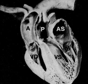 Trasposizione Grandi Arterie Anatomia Concordanza atrioventricola re Discordanza