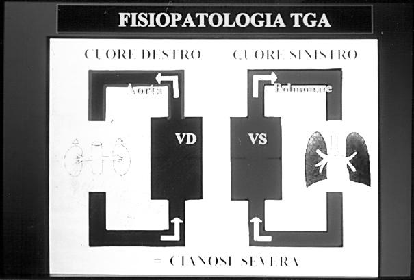 Fisiopatologia Gran parte della GS di un ventricolo ritorna allo stesso ventricolo Circolazioni sistemica e polmonare in parallelo Ridotto apporto di O 2 ai tessuti: