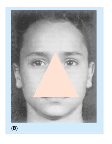 Importanza clinica delle vie di comunicazione tra vena facciale e seno cavernoso/pterigoideo Triangolo pericoloso della faccia FERITE A LIVELLO DEL