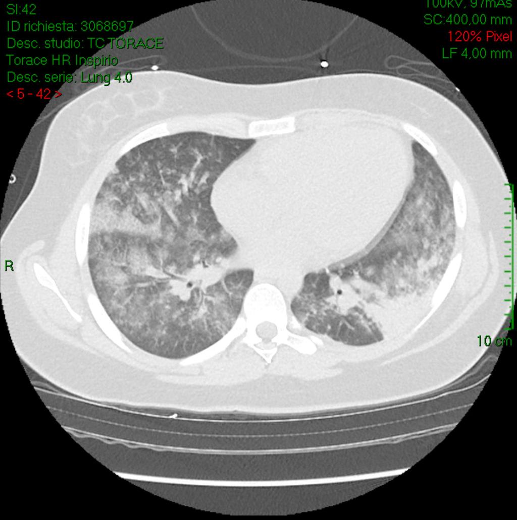 Fig. 1. Infiltrati polmonari bilaterali a vetro smerigliato Pressure)con necessità continua di sedazione alla TC del torace. e curarizzazione.
