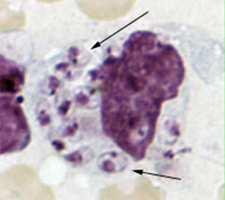 Percorso diagnostico -- Esame diretto (es. da materiale prelevato con biopsia del midollo osseo, della milza, ecc.