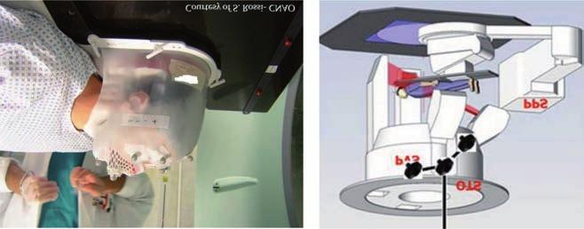Quando il piano di trattamento prevede l impiego non solo di protoni ma anche di ioni (ad esempio per distruggere la parte radio-resistente del tumore), il paziente non viene spostato mentre in tempi