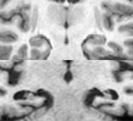 MRI in AD Brain atrophy predominantly at the level of the temporal lobes Hippocampal