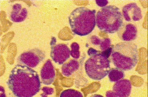 Leucemia linfoblastica acuta Con ridotta frequenza afferiscono al Centro pazienti candidati al trapianto in quanto affetti da patologie non neoplastiche quali: anemia aplastica severa anemia