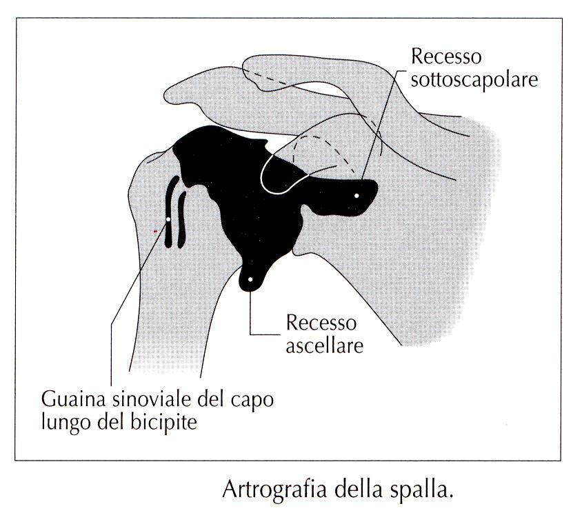 L iniezione di un mezzo di contrasto permette di visualizzare