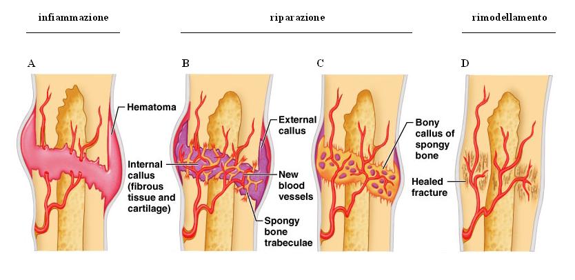 Figura 1: processo di guarigione ossea in seguito a frattura 1.