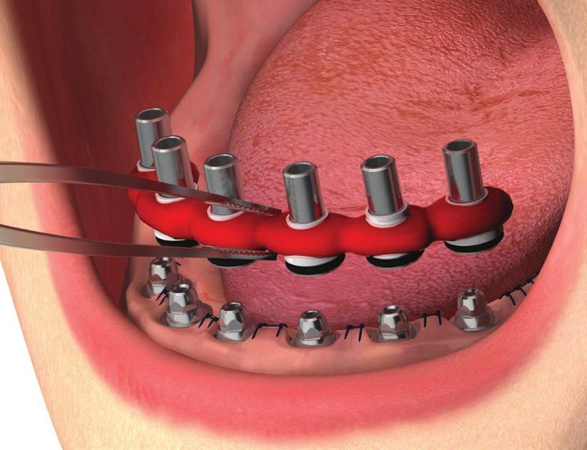 A Creare una struttura in resina calcinabile sui PAD-CC-LV con l