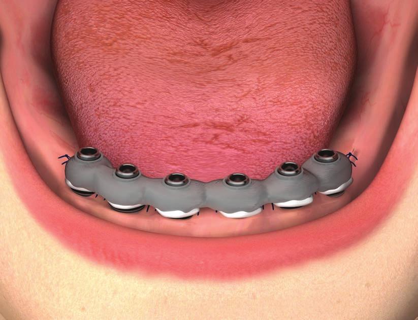 RIABILITAZIONE DEFINITIVA CON ABUTMENT P.A.D. A incollaggio avvenuto, qualora fosse necessario, il tecnico potrà accorciare le cannule secondo la dimensione verticale del paziente.