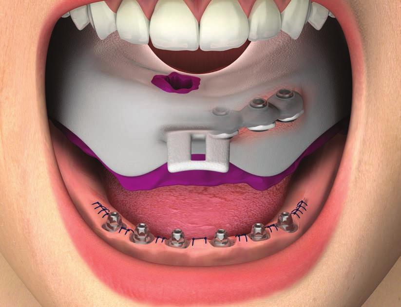 PROTOCOLLI DI UTILIZZO Svitare la vite