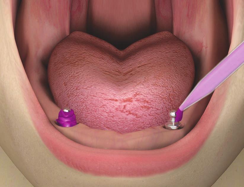 Posizionare il cucchiaio chiuso, in modo da verificare che tutta l altezza dell attacco sferico sia contenuta all interno delle pareti del portaimpronta.