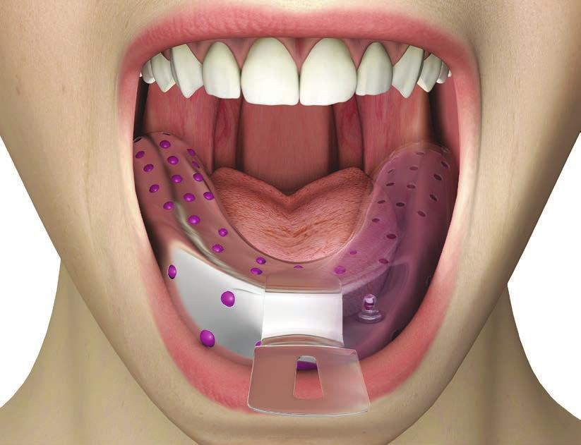 Sollevare il cucchiaio portaimpronta verticalmente.