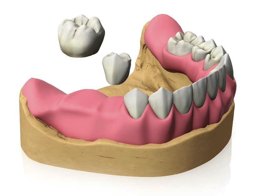 PROTOCOLLI DI UTILIZZO Cappetta in lega aurea CAP-1: metodo indiretto Posizionare le cappette assemblate all anello in plastica sulla testa sferica degli analoghi, avendo cura di mantenere l asse di